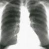 Rx radiografias -reciclado de placas de radiografias